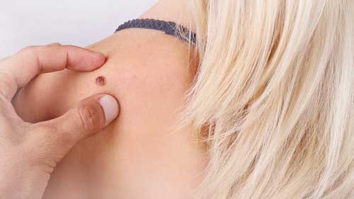 Hpv site baf