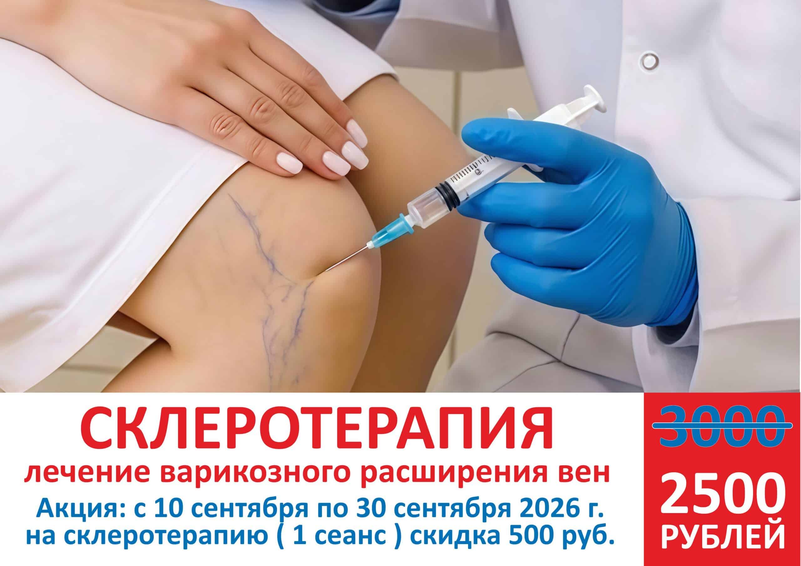 Акция склеротерапия